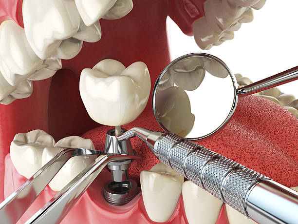 Best Broken Tooth Emergency  in Mendon, UT
